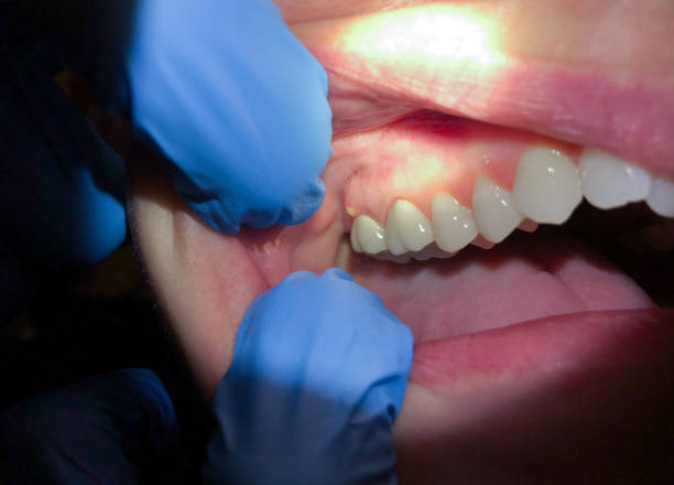 Best Emergency Treatment for Dental Infections or Abscesses in Riverside, AL