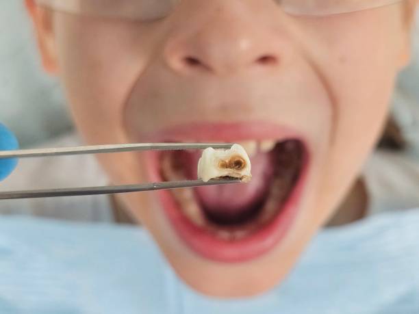 Best Emergency Treatment for Dental Infections or Abscesses in Riverside, AL
